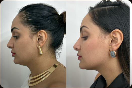 Antes e depois de paciente HiPRO, perfil com brincos